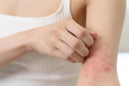 Card image of Eczema uses