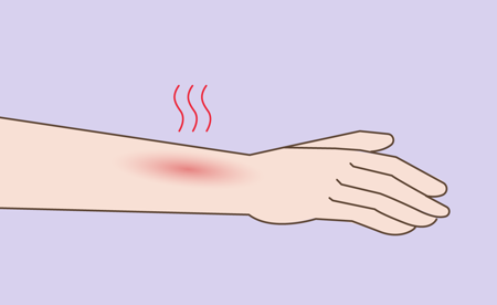 Card Illustration of burning skin