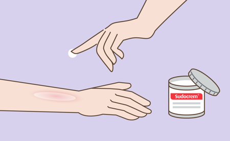 Card image of Application of Sudocrem on burnt skin