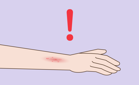 Image of Exclamation point next to burnt arm 