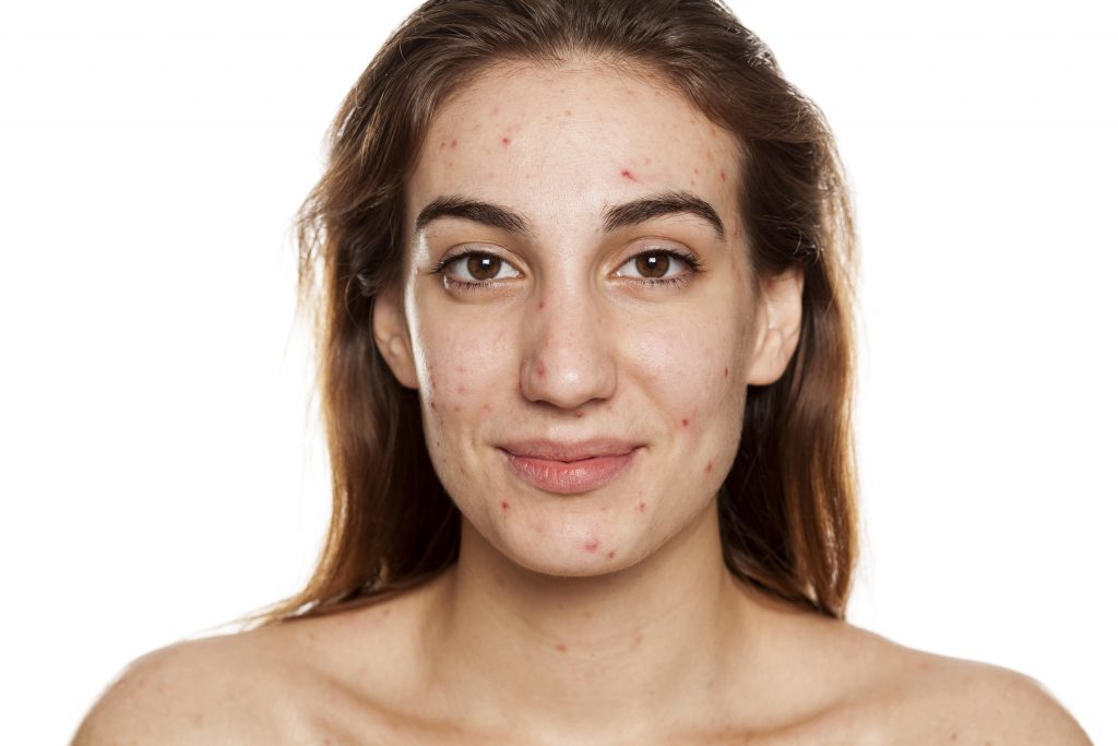 Woman with acne smiling at camera